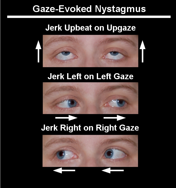 Update1 anatom e Updater Viewer Media Nystagmus 